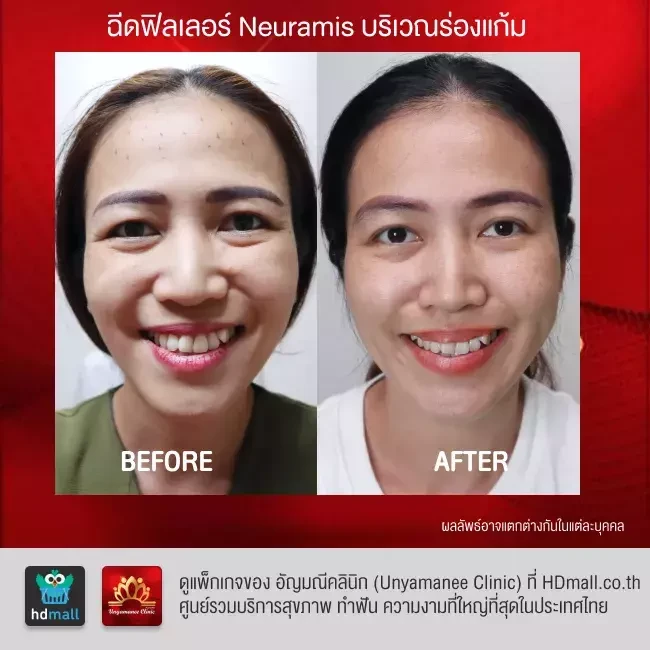 รีวิว ฉีดฟิลเลอร์ ที่ อัญมณีคลินิก Unyamanee clinic