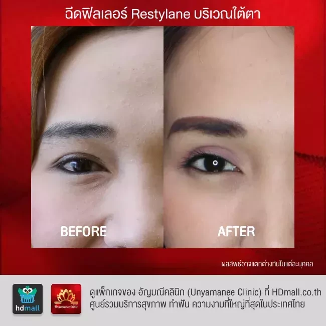 รีวิว ฉีดฟิลเลอร์ ที่ อัญมณีคลินิก Unyamanee clinic