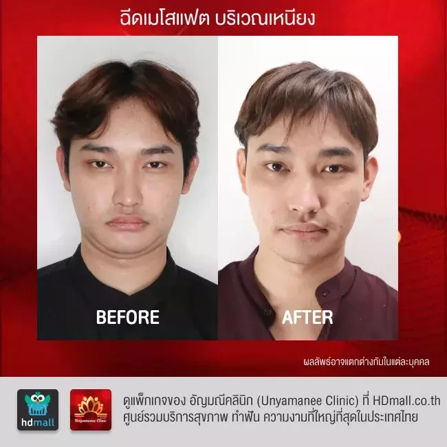 รีวิว ฉีดเมโสแฟต สลายไขมัน ที่ อัญมณีคลินิก Unyamanee clinic