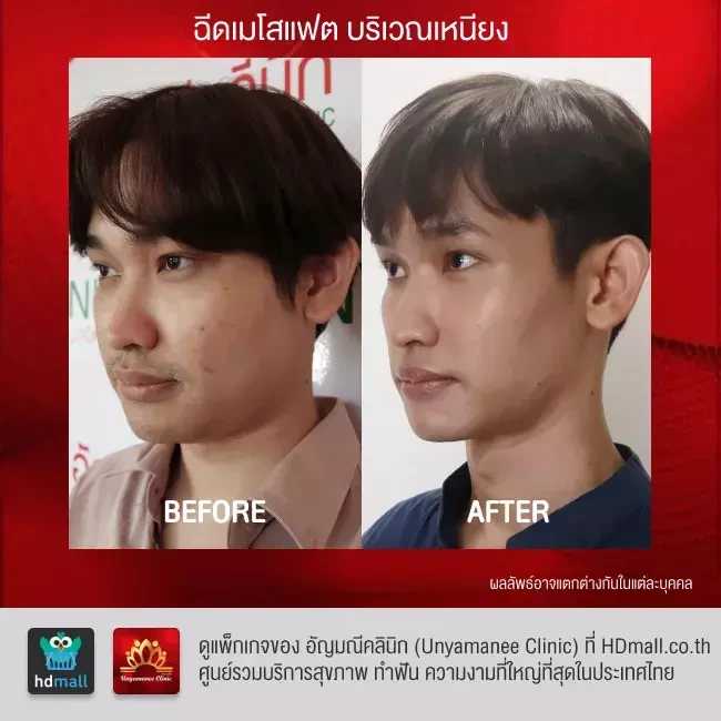 รีวิว ฉีดเมโสแฟต สลายไขมัน ที่ อัญมณีคลินิก Unyamanee clinic