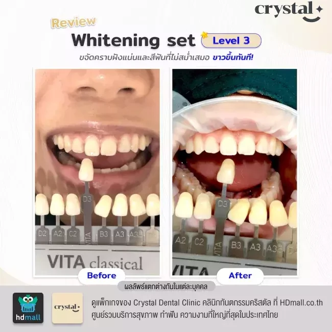 รีวิว ฟอกสีฟัน ที่ Crystal Dental Clinic คลินิกทันตกรรมคริสตัล
