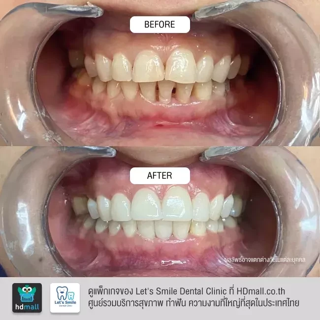 รีวิว ฟอกสีฟัน ที่ Let's Smile Dental Clinic