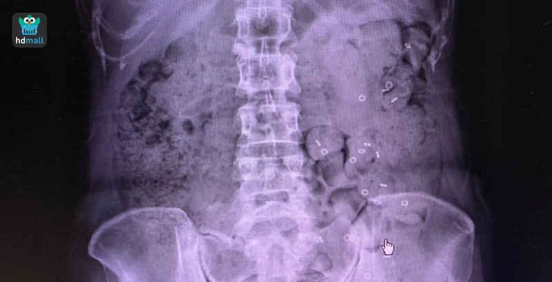 ภาพเอกซเรย์ผลตรวจวินิจฉัยภาวะลำไส้ขี้เกียจ (Slow Transit Constipation) สาเหตุของอาการท้องผูก