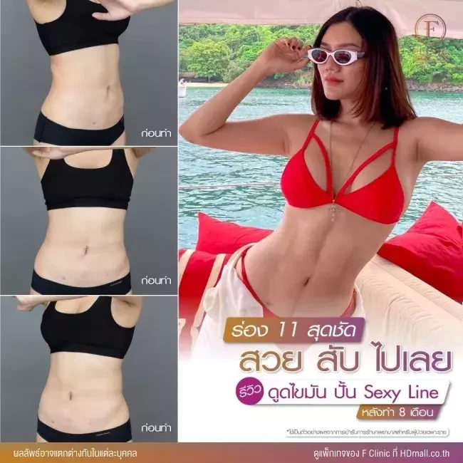 รีวิว ดูดไขมันบริเวณหน้าท้อง ทำ Sexy Line ที่ F Clinic