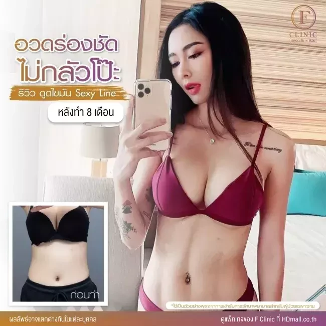 รีวิว ดูดไขมันบริเวณหน้าท้อง ทำ Sexy Line ที่ F Clinic