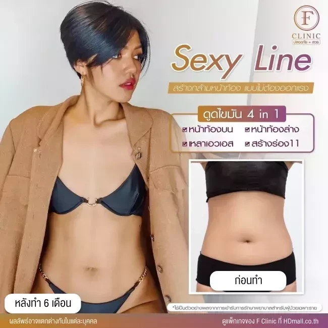 รีวิว ดูดไขมันบริเวณหน้าท้อง ทำ Sexy Line ที่ F Clinic