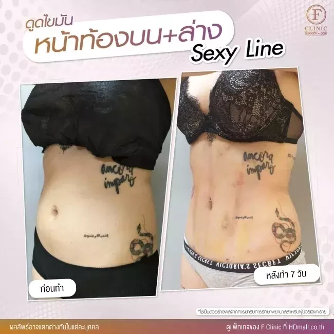 รีวิว ดูดไขมันบริเวณหน้าท้อง ทำ Sexy Line ที่ F Clinic