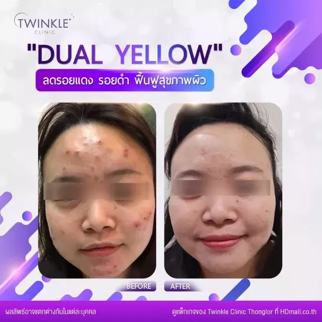 รีวิว Dual Yellow Laser ลดรอยดำ รอยแดงบนใบหน้า ที่ Twinkle Clinic Thonglor