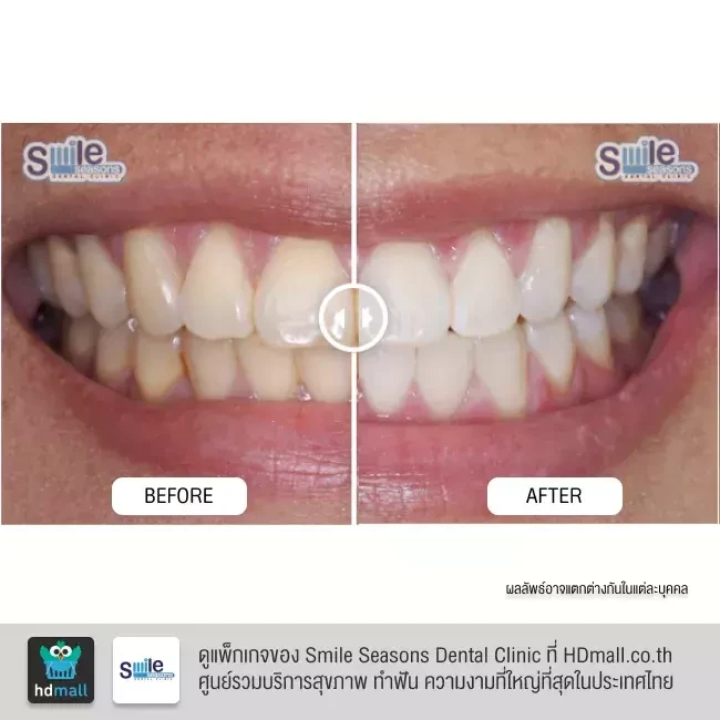 รีวิว ฟอกสีฟัน ที่ Smile Seasons Dental Clinic (คลินิกทันตกรรมสไมล์ซีซันส์)