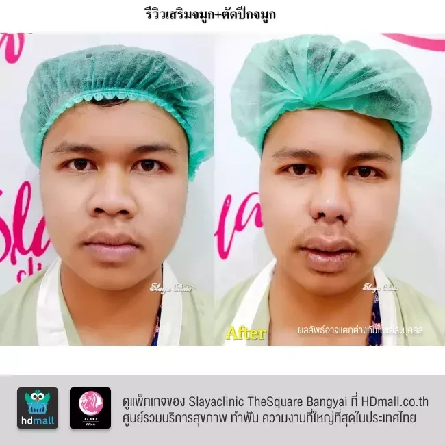 รีวิว เสริมจมูก ที่ Slayaclinic TheSquare Bangyai