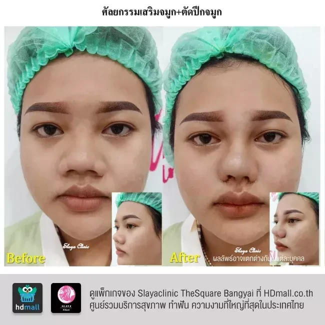 รีวิว ตัดปีกจมูก ที่ Slayaclinic TheSquare Bangyai