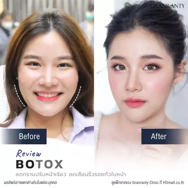 รีวิว ฉีดโบท็อกซ์ ลดกราม ปรับหน้าเรียว ที่ Granranty Clinic