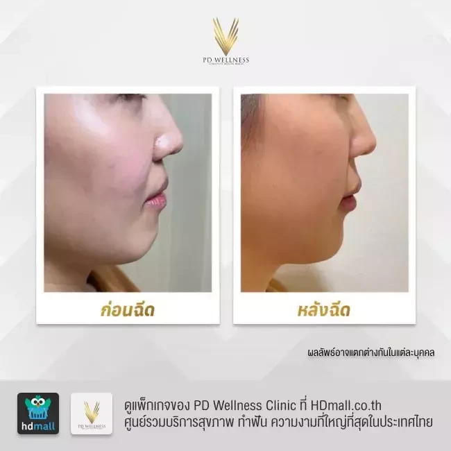 รีวิว ฉีดฟิลเลอร์ ที่ PD Wellness Clinic