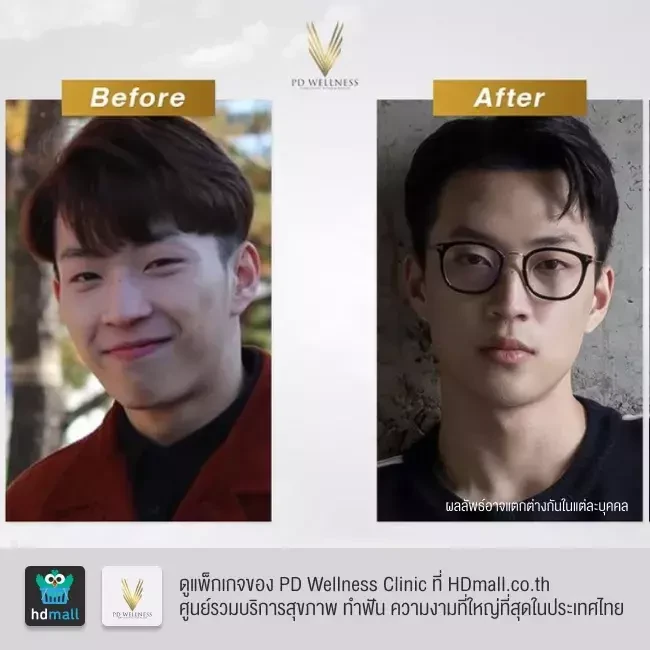 รีวิว ฉีดฟิลเลอร์ ที่ PD Wellness Clinic