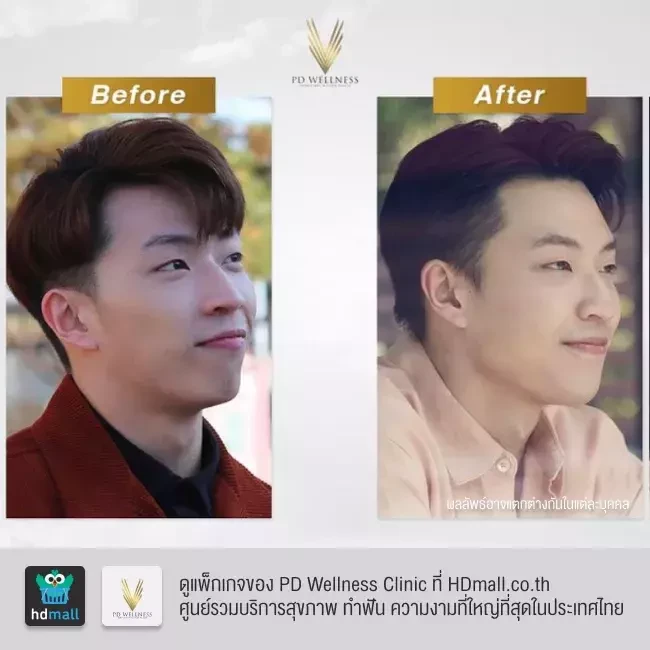 รีวิว ฉีดฟิลเลอร์ ที่ PD Wellness Clinic