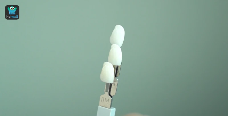 ตัวอย่างวีเนียร์ แปะฟันขาว ที่ TDH