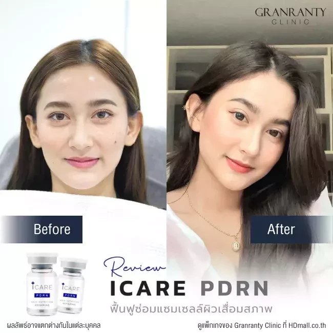 รีวิว ICARE PDRN ที่ Granranty Clinic