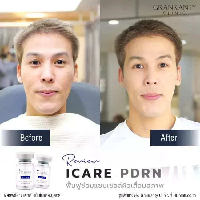 รีวิว ICARE PDRN ที่ Granranty Clinic