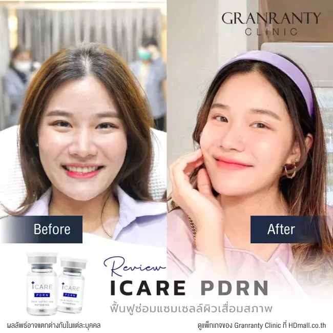 รีวิว ICARE PDRN ที่ Granranty Clinic