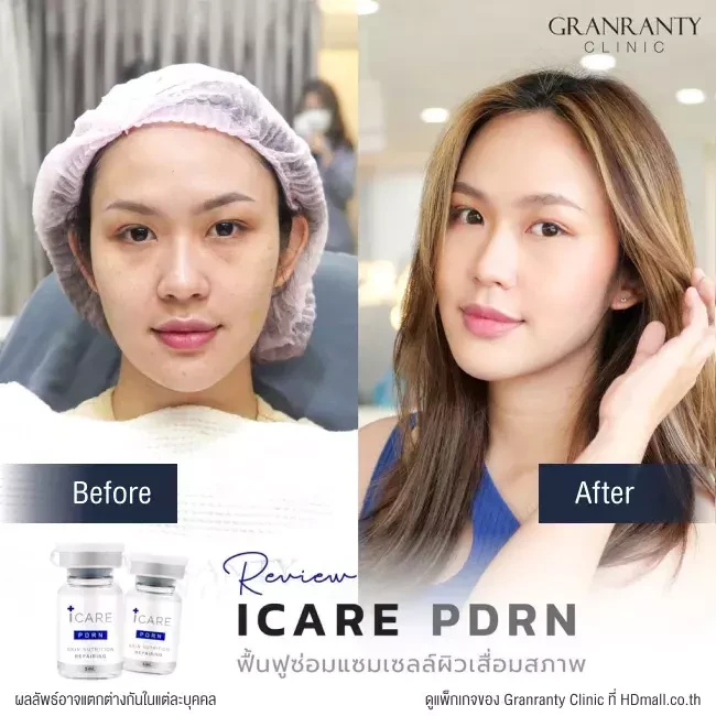 รีวิว ICARE PDRN ที่ Granranty Clinic