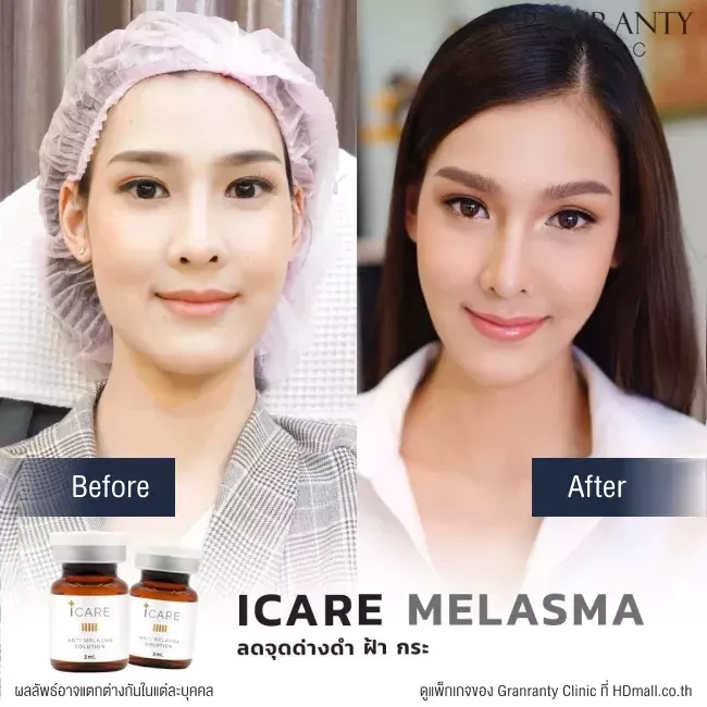 รีวิว ICARE PDRN ที่ Granranty Clinic