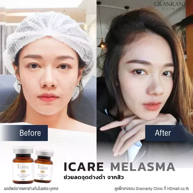 รีวิว ICARE PDRN ที่ Granranty Clinic