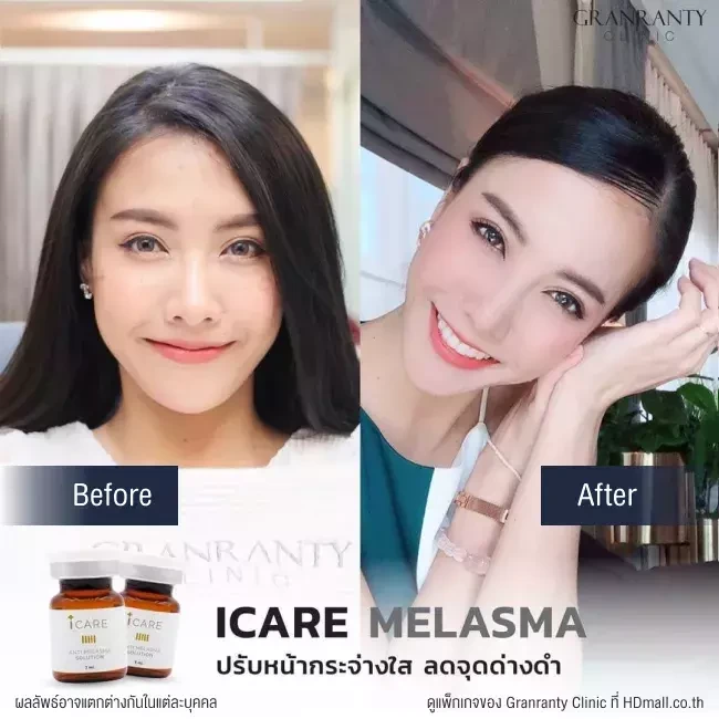 รีวิว ICARE PDRN ที่ Granranty Clinic