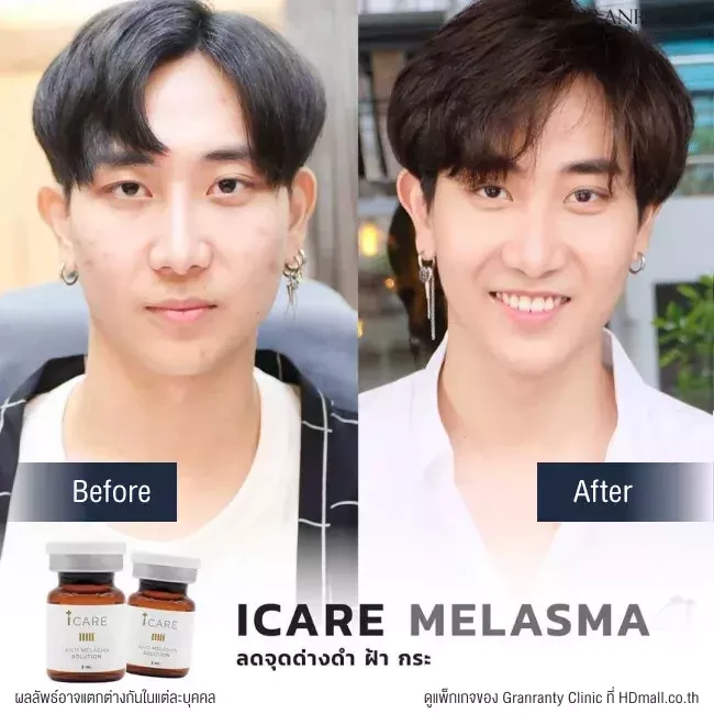 รีวิว ICARE PDRN ที่ Granranty Clinic