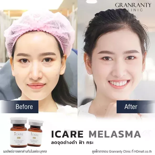 รีวิว ICARE PDRN ที่ Granranty Clinic