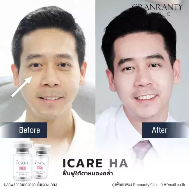 รีวิว ICARE PDRN ที่ Granranty Clinic