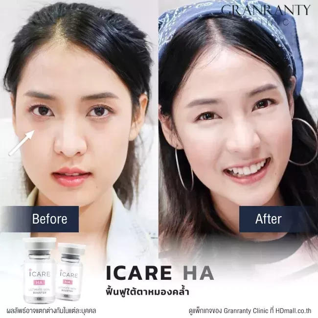 รีวิว ICARE PDRN ที่ Granranty Clinic