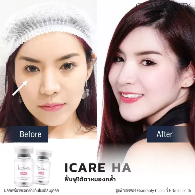 รีวิว ICARE PDRN ที่ Granranty Clinic