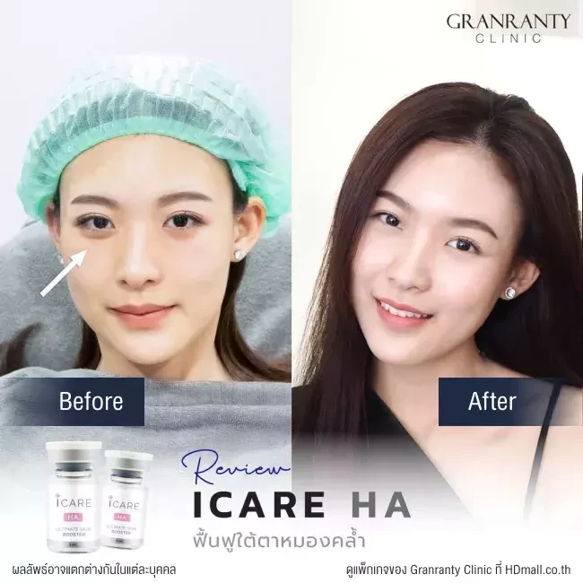 รีวิว ICARE PDRN ที่ Granranty Clinic