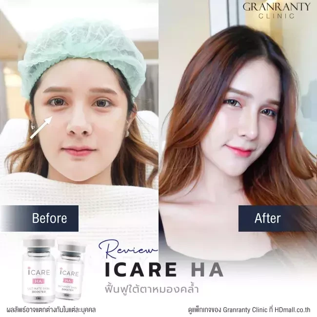 รีวิว ICARE PDRN ที่ Granranty Clinic