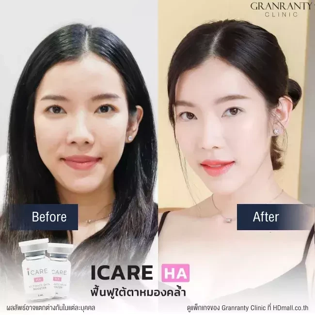 รีวิว ICARE PDRN ที่ Granranty Clinic