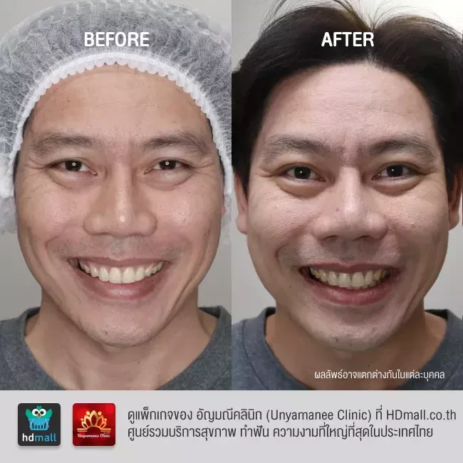 รีวิว ฉีดโบท็อกซ์ ที่ อัญมณีคลินิก Unyamanee clinic