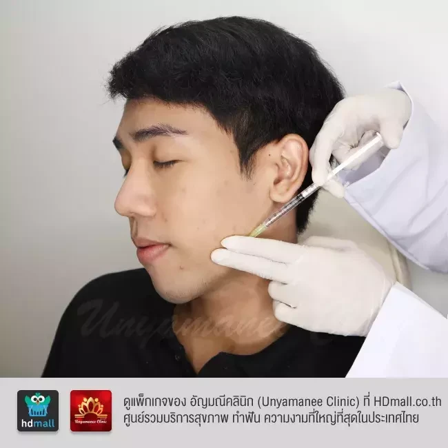 รีวิว ฉีดโบท็อกซ์ ที่ อัญมณีคลินิก Unyamanee clinic