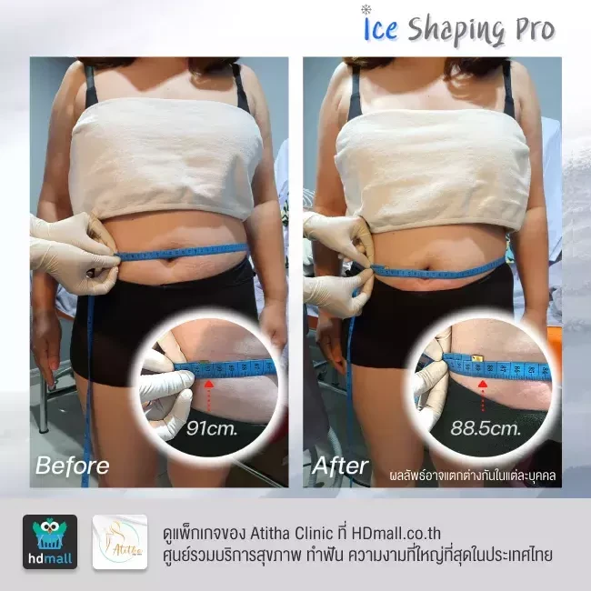 รีวิว สลายไขมันด้วยความเย็น Ice Shaping Pro ที่ Atitha Clinic
