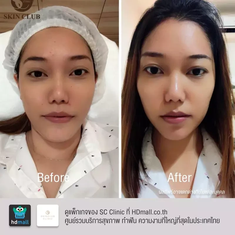 รีวิว ฉีดโบท็อกซ์ ที่ SC Clinic รูปที่ 5