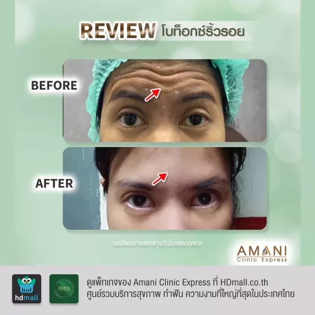 รีวิว ฉีดโบท็อกซ์ ลดริ้วรอย ที่ Amani Clinic Express รูปที่ 1