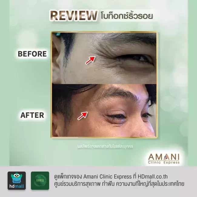 รีวิว ฉีดโบท็อกซ์ ลดริ้วรอย ที่ Amani Clinic Express รูปที่ 2