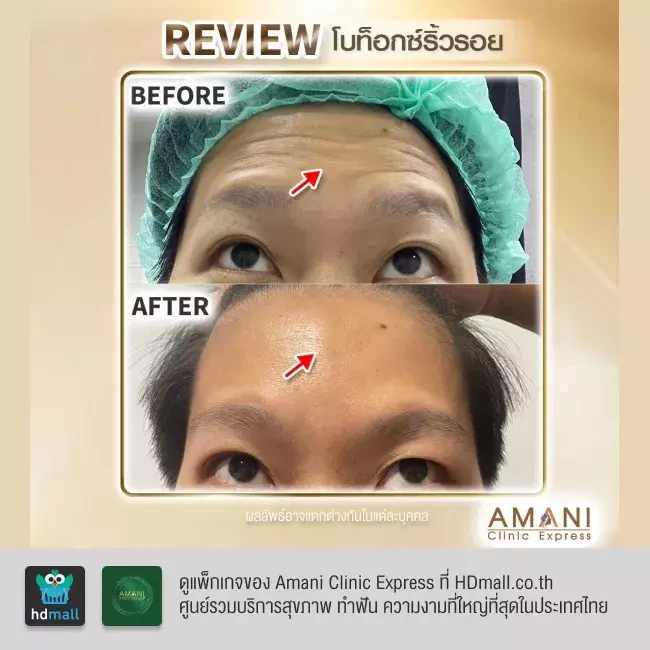 รีวิว ฉีดโบท็อกซ์ ลดริ้วรอย ที่ Amani Clinic Express รูปที่ 3