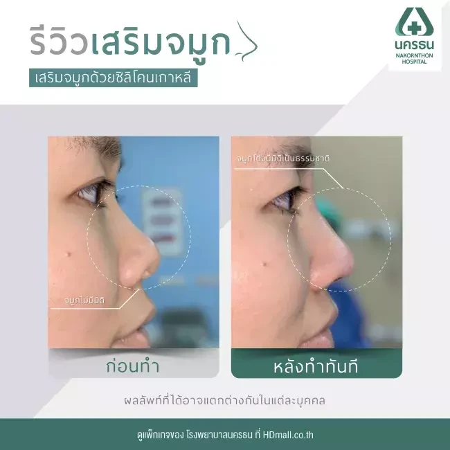 รีวิว เสริมจมูก ที่ โรงพยาบาลนครธน รูปที่ 2