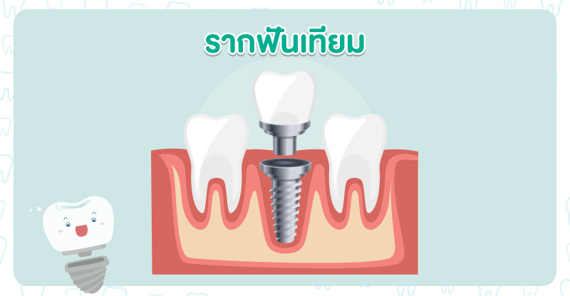 รากฟันเทียมคืออะไร