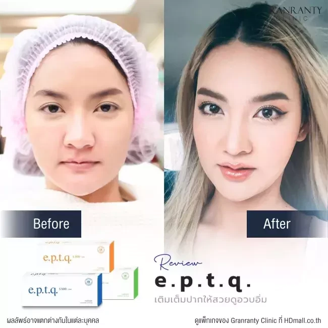 รีวิว ฉีดฟิลเลอร์ปาก ที่ Granranty Clinic รูปที่ 1