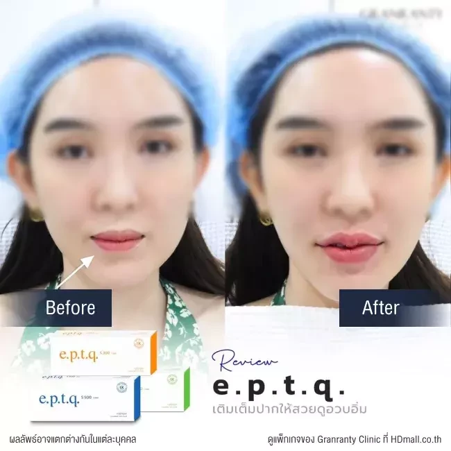 รีวิว ฉีดฟิลเลอร์ปาก ที่ Granranty Clinic รูปที่ 3