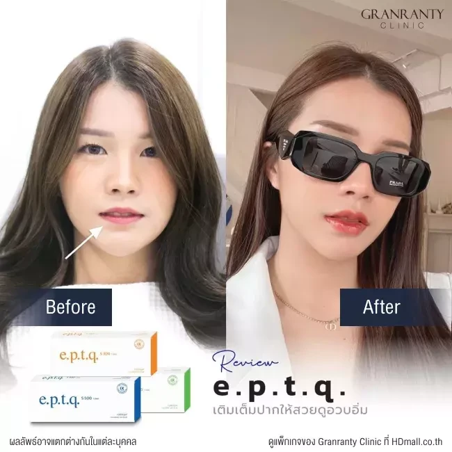 รีวิว ฉีดฟิลเลอร์ปาก ที่ Granranty Clinic รูปที่ 5