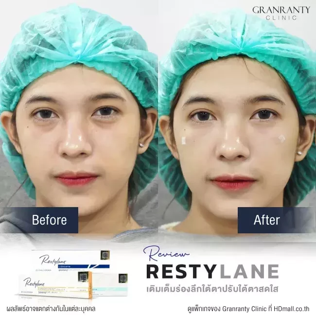 รีวิว ฉีดฟิลเลอร์ใต้ตา ที่ Granranty Clinic รูปที่ 1