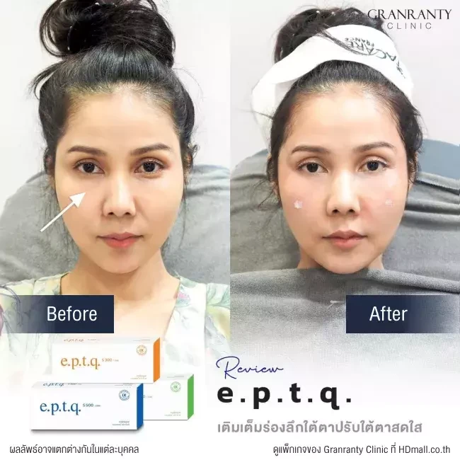 รีวิว ฉีดฟิลเลอร์ใต้ตา ที่ Granranty Clinic รูปที่ 2