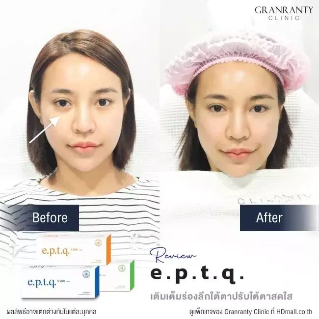 รีวิว ฉีดฟิลเลอร์ใต้ตา ที่ Granranty Clinic รูปที่ 3